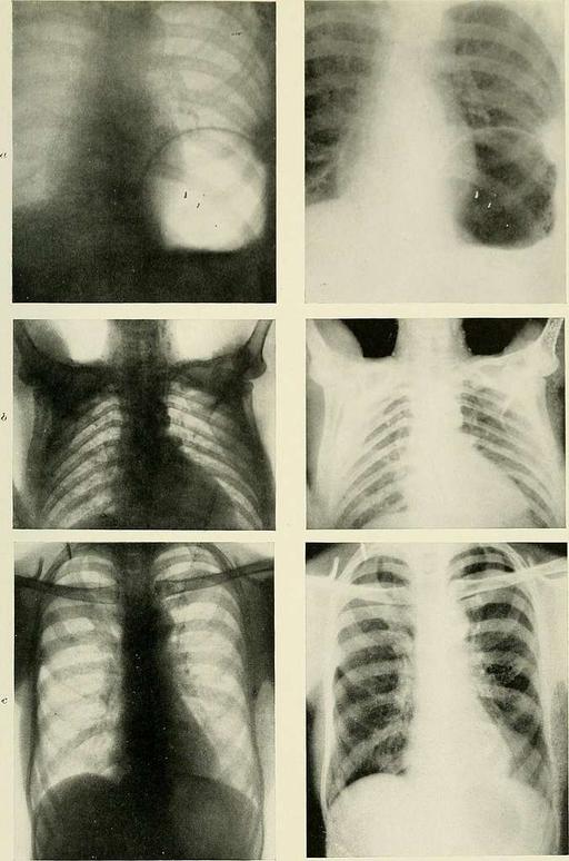 Radiography, x-ray therapeutics and radium therapy (1915)… — PICRYL ...